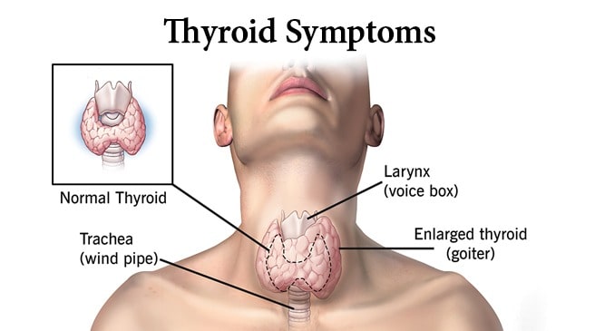 Thyroid symptoms in Hindi: थायरॉइड क्या है? थायरॉइड का आयुर्वेदिक उपचार